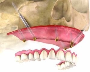 Impianti zigomatici: una soluzione per gravi atrofie ossee
