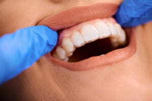 apparecchio invisibile costi alternative e prezzi di invisalign