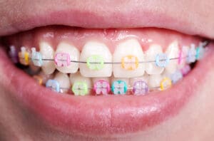 consigli per il primo apparecchio dentale