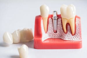 impianti dentali economici in italia 2