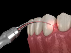 cura per la parodontite laser e trattamenti efficaci