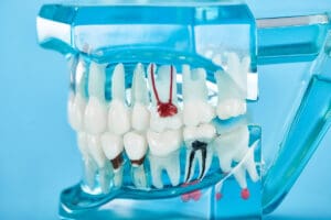 cura per la parodontite laser e trattamenti efficaci