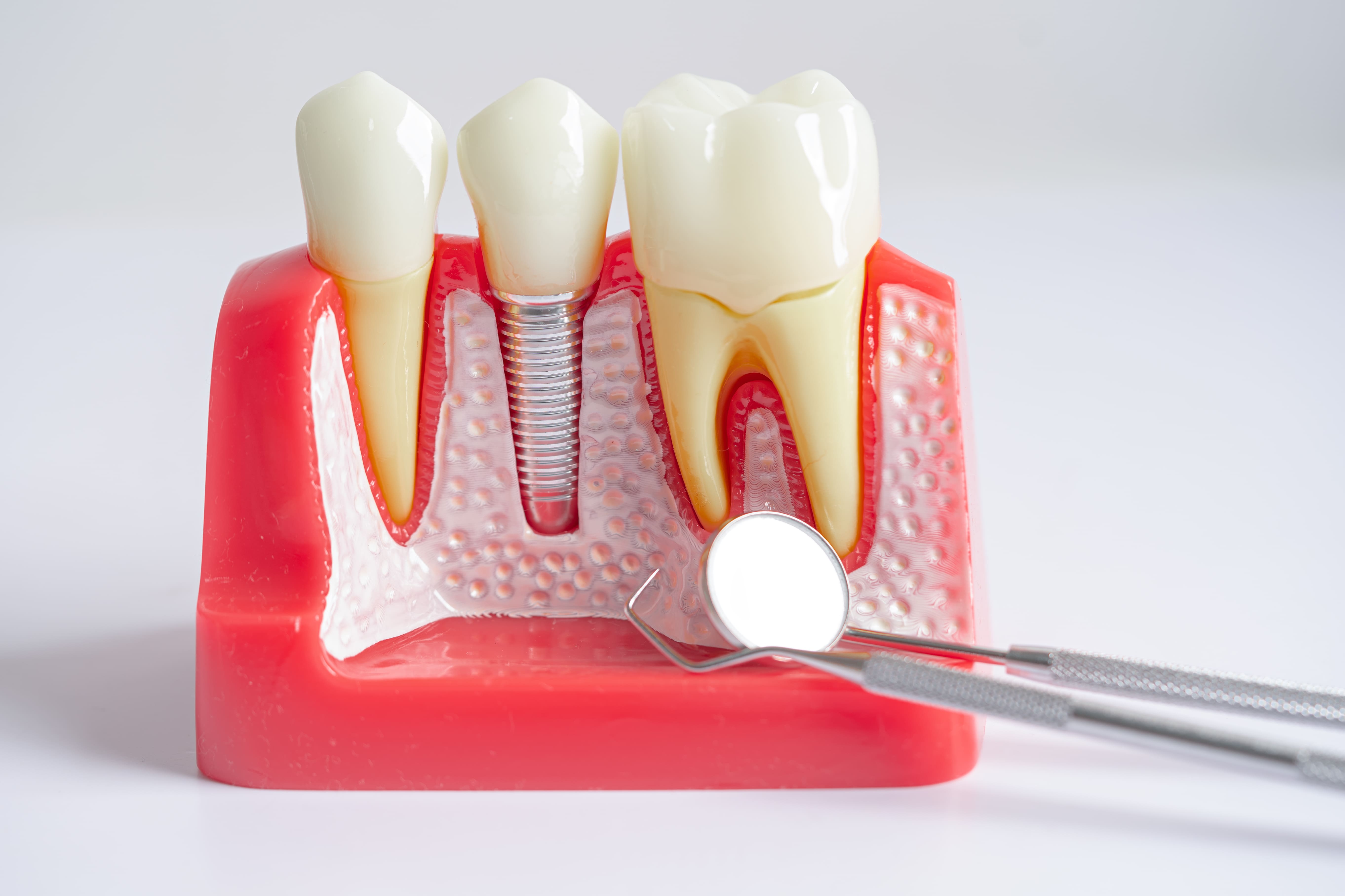 il 9 migliori cemento dentale: Guida PROFESSIONALE del 2024 